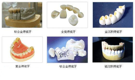 🌟镶牙材料与价格表全解析🌟